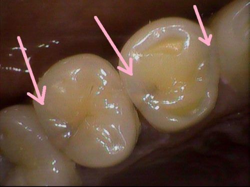 歯と歯の間の虫歯