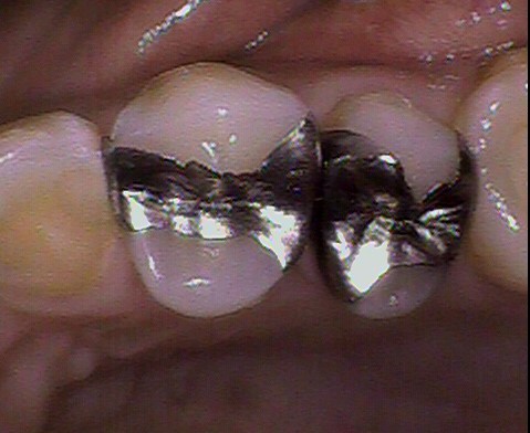 歯と歯の間のむし歯を保険診療で治療