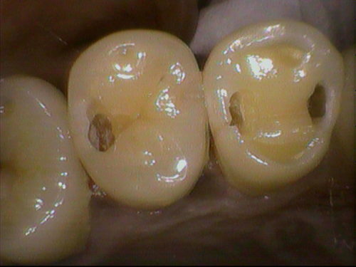 確実な齲蝕の除去、歯の切削量は最小限