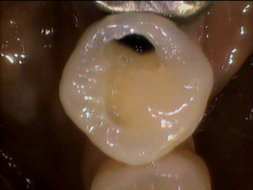 歯と歯の間のむし歯