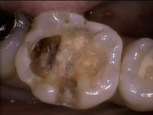金属の詰めものの下のむし歯