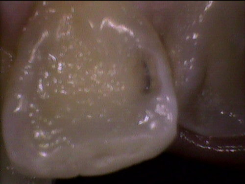 前歯のむし歯